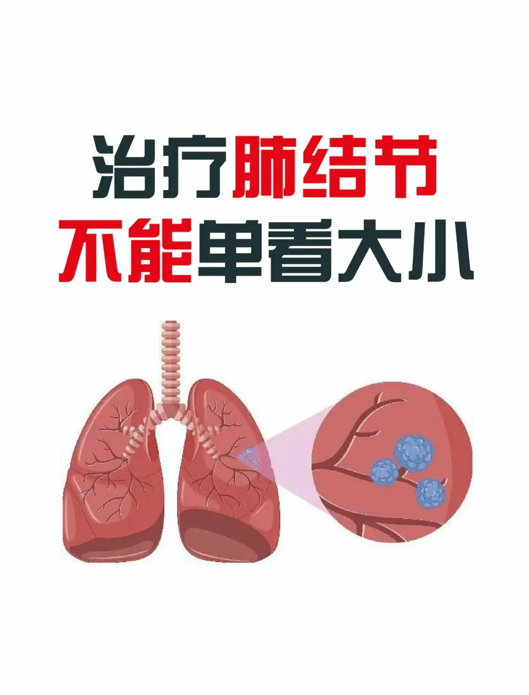 肺结节部位消融手术